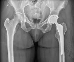 Best Hip Replacement Surgeon